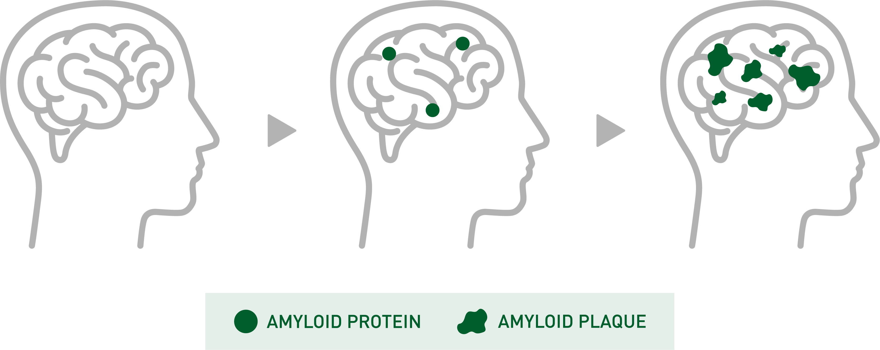 amyloid plaque buildup in brain figure