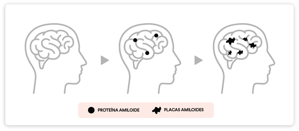 Figura de la acumulación de placa amiloide en el cerebro