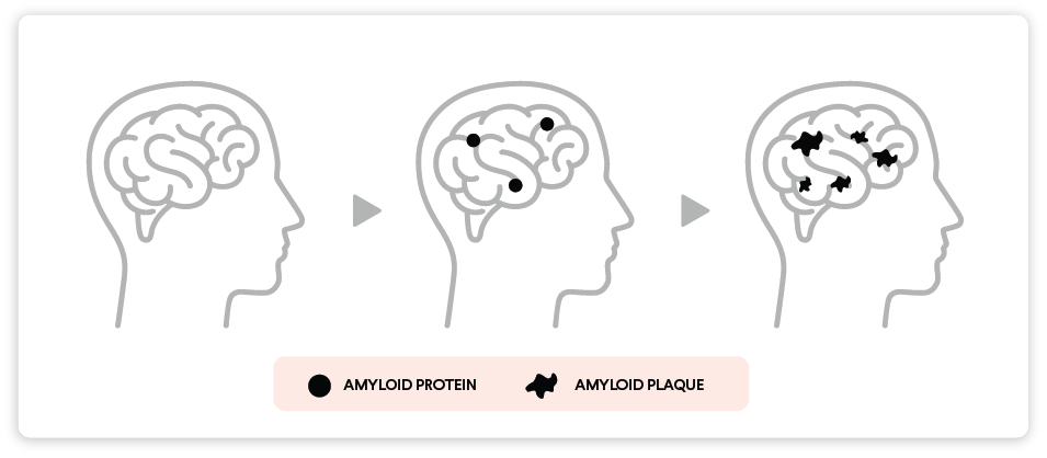 amyloid plaque buildup in brain figure
